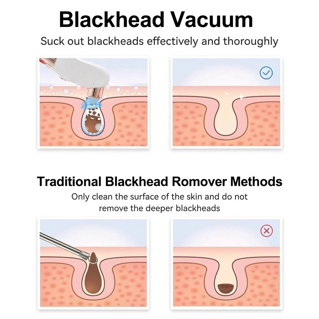 ManiRenew Deluxe Blackhead Remover Pore Vacuum Cleaner