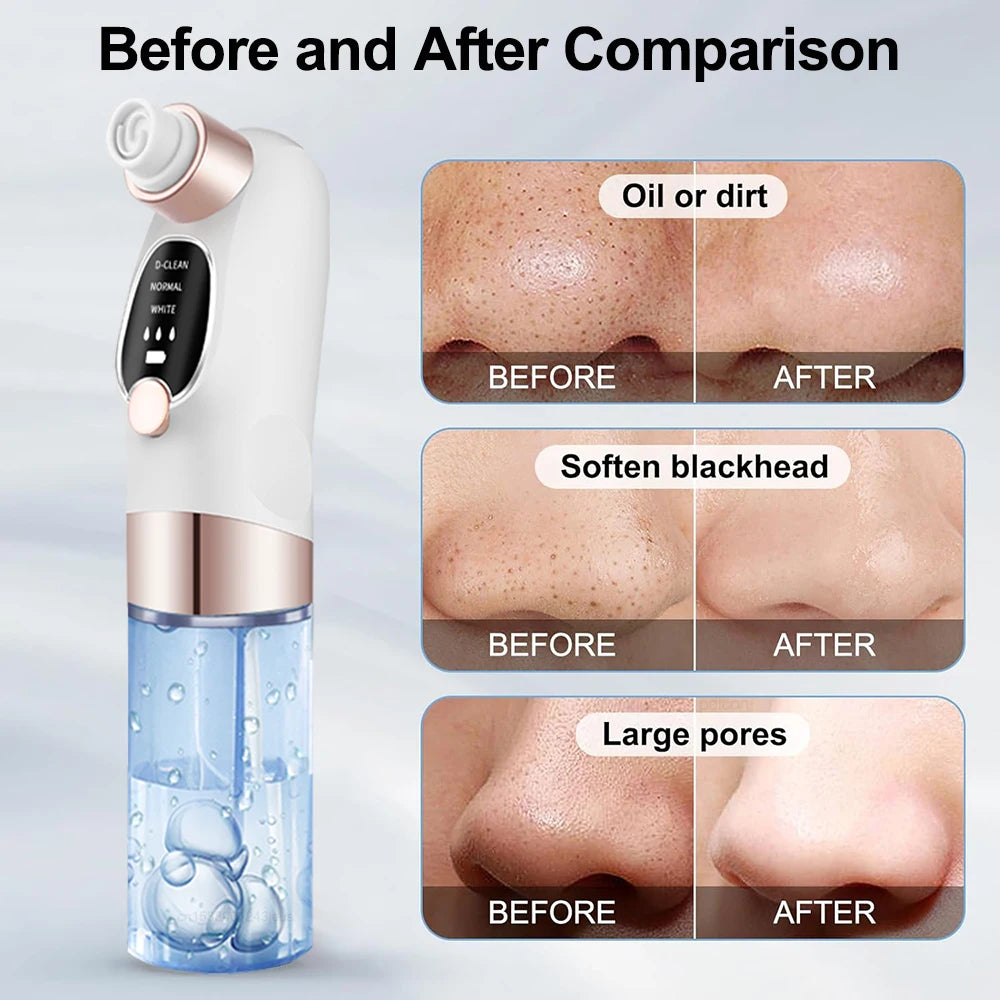 ManiRenew Deluxe Blackhead Remover Pore Vacuum Cleaner